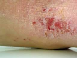 herpes rash on leg #10