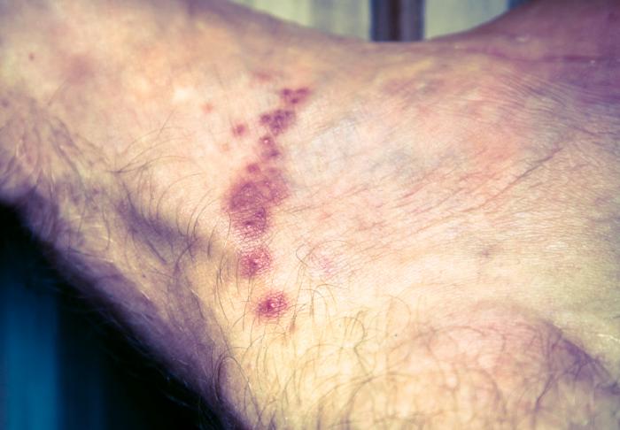 photos of scabies rash