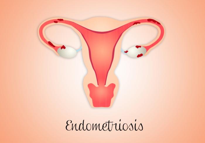 Causes of Endometriosis