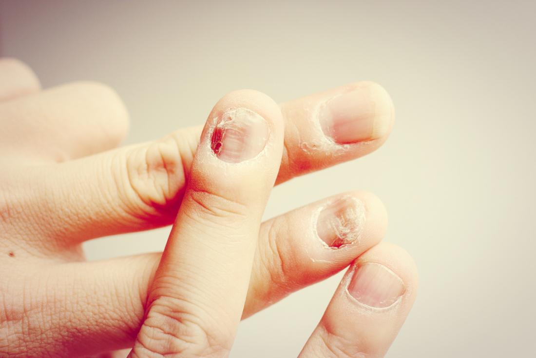 Nail Fungal Infection Causes Treatment And Symptoms Medical News Today
