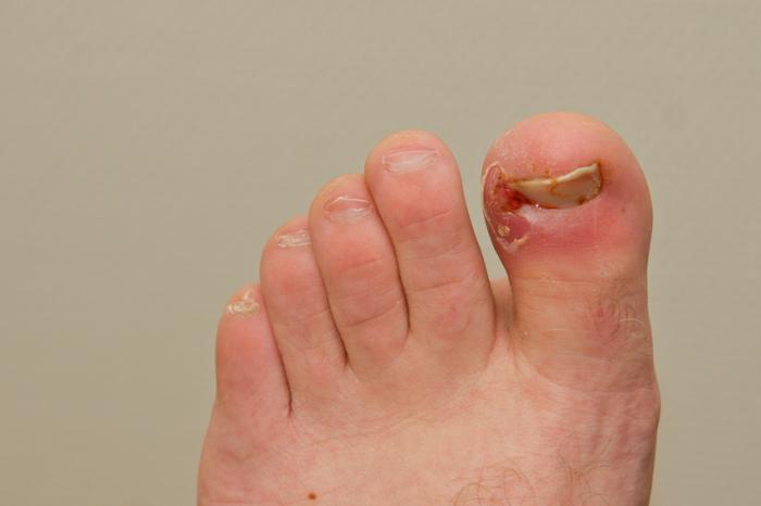 What causes an ingrown toenail?