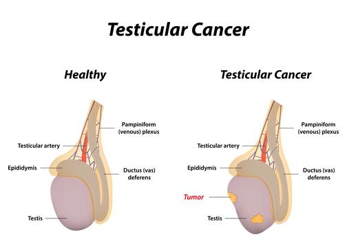 What causes testicular hernia pain?
