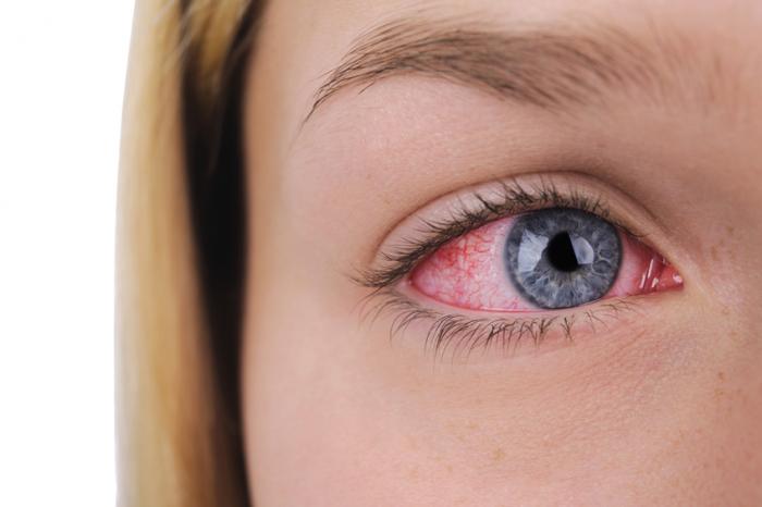 Can children have eye strokes?
