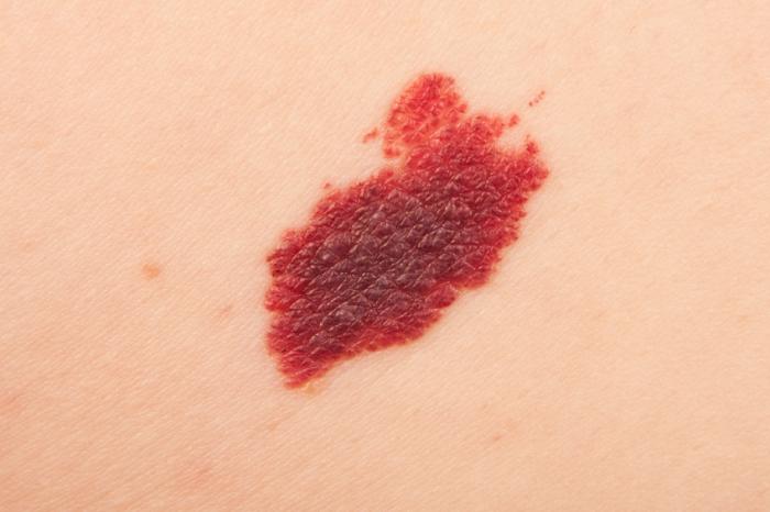 Birthmarks: Causes, Types and Treatments - Medical News Today