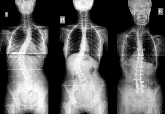 What is mild scoliosis of the thoracic spine?