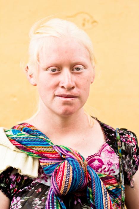 Albinism: Symptoms, Causes and Diagnosis