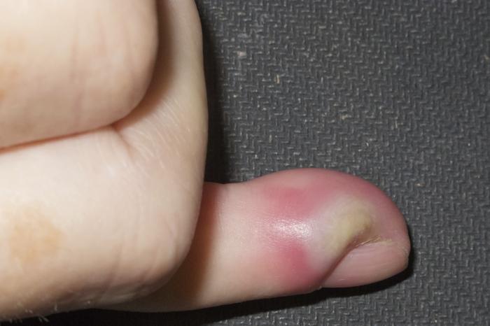 Are swollen fingers a cause for alarm?