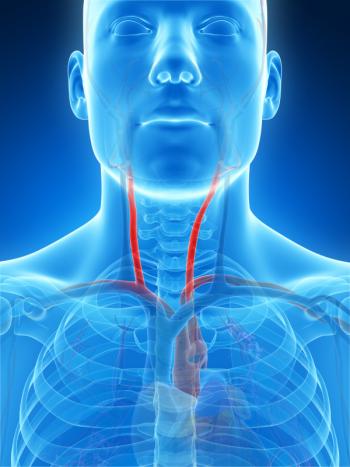 Narrowing of the carotid arteries may lead to memory and thinking