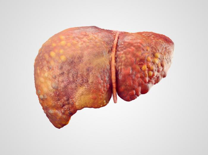 Medical News Today: Nonalcoholic fatty liver disease: Hormone that limits fibrosis discovered
