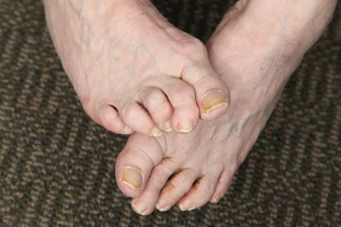 What is the treatment for hammertoe?