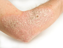 What Are Ways to Manage Symptoms and Treat Psoriasis ...
