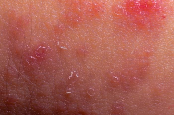 Common Adult Skin-Problem Pictures: Identify Rashes ...