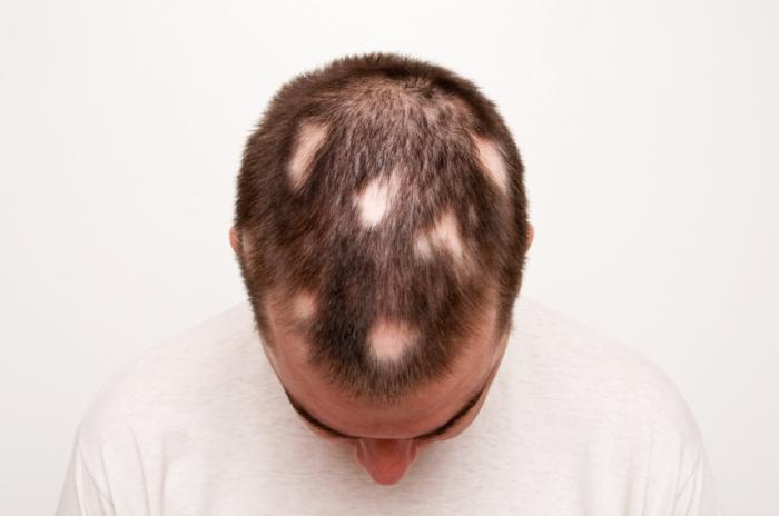 Hair loss Causes - Mayo Clinic