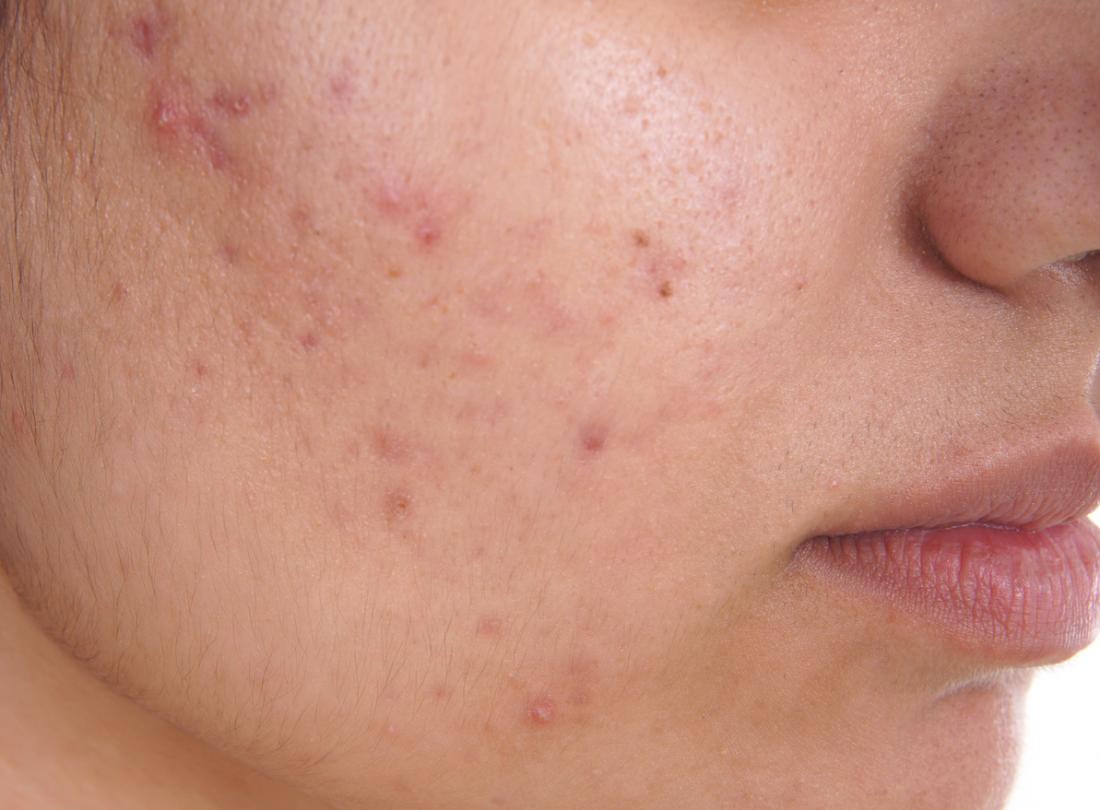 Acne: Causes, Diagnosis and How to Get Rid of Acne