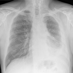 A digital chest x-ray of advanced malignant mesothelioma