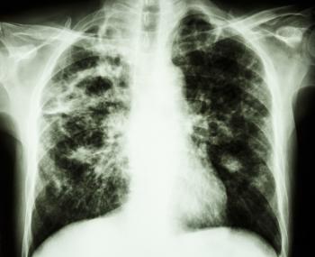x ray of pulmonary fibrosis
