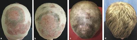 patient baldness before and after treatment