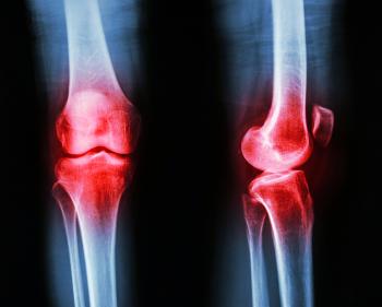 x ray of osteoarthritis
