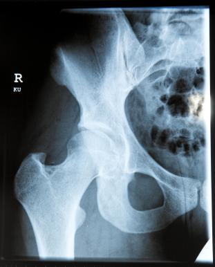 hip x ray