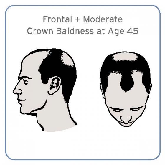 illustration of frontal and moderate crown baldness