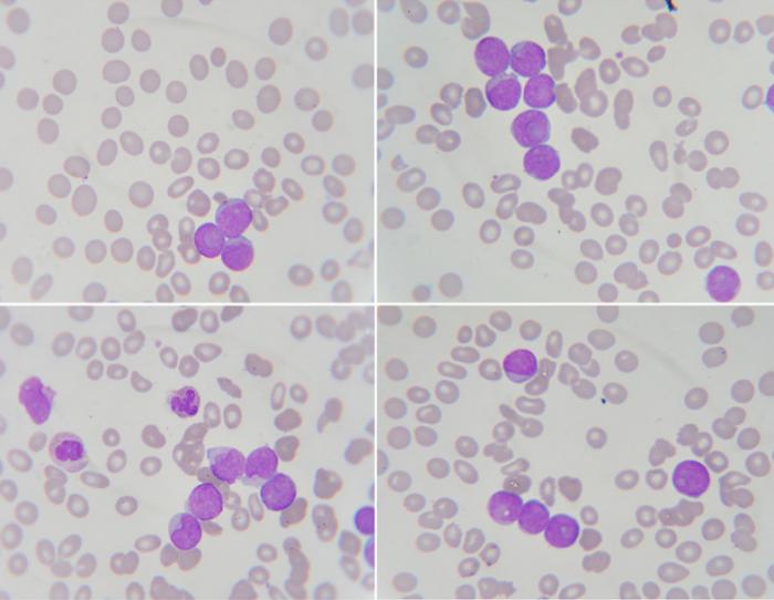 blood smear showing neutrophil, white blood cell and leukemia