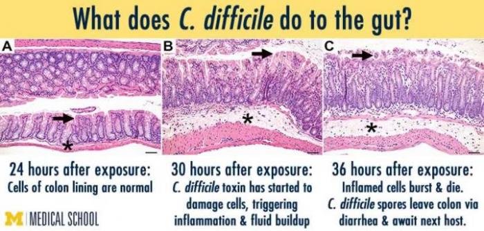 effect of c difficile on gut lining of cells