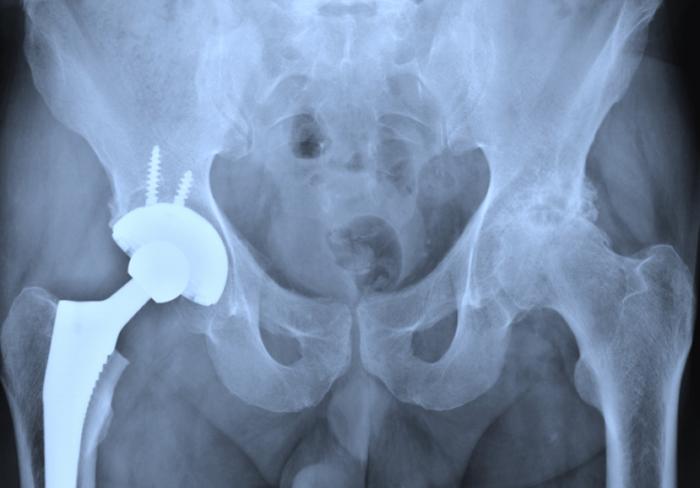 X-ray of a hip replacement