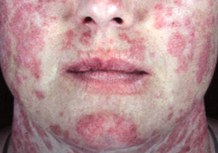 What are some signs of lupus?