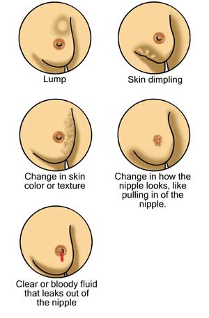 En Breast cancer illustrations