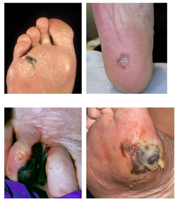 Foot melanoma examples