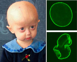 Photo of a child with Progeria