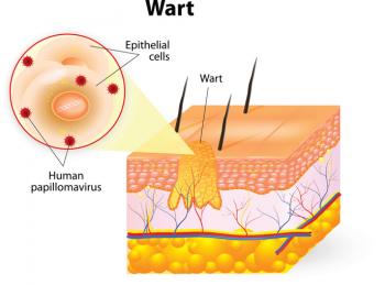hpv warts skin tags private parts