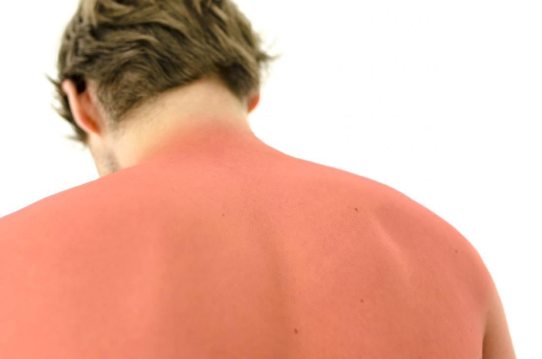 Vitamin D May Help To Treat Sunburn Study Suggests
