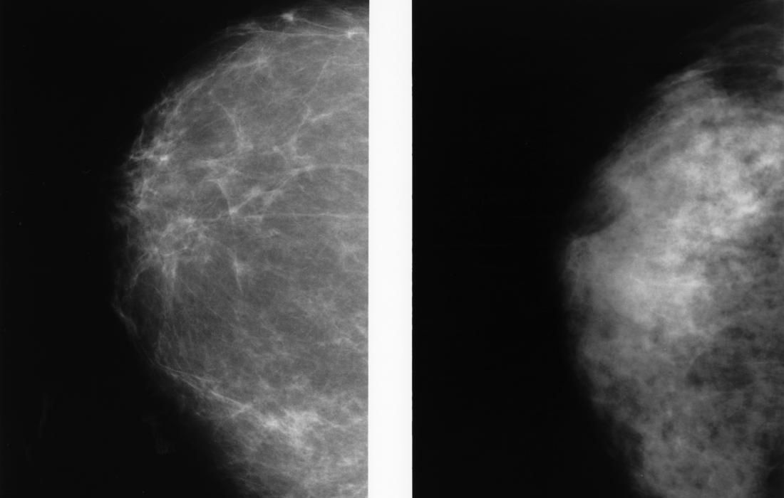 breast, Dense breast tissue: All you need to know