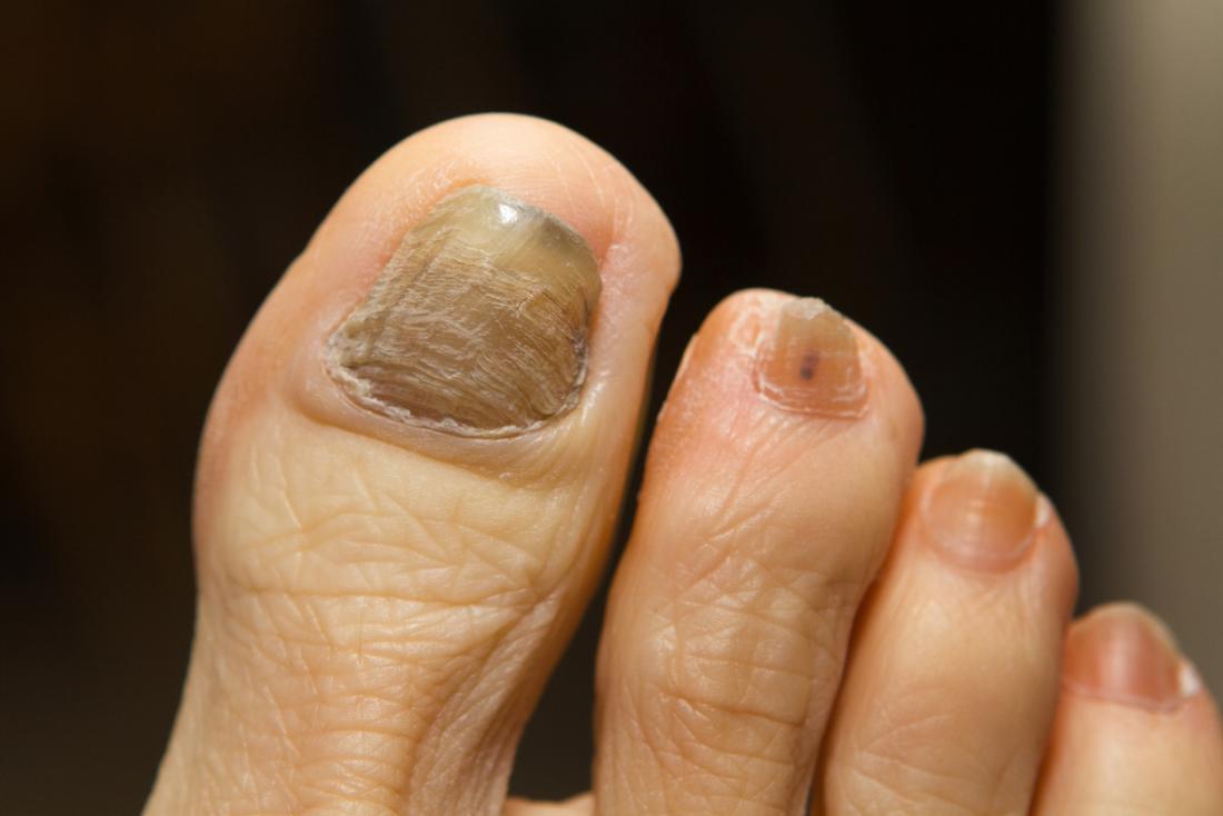 thick toenails, Why do toenails become thick?