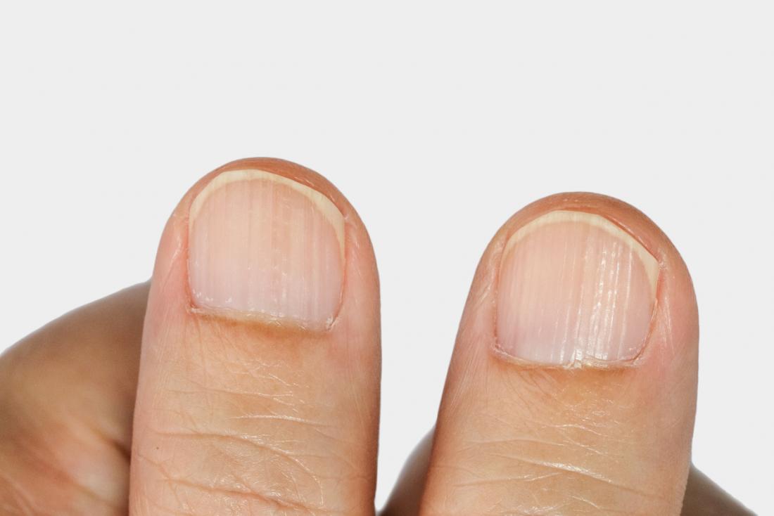 Ridges in fingernails, All you need to know about ridges in fingernails