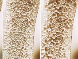 Osteoporosis explained