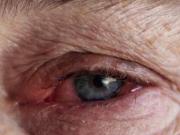 What is infective conjunctivitis, or pink eye?