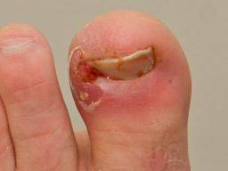 What to do about an ingrown toenail