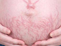 What are stretch marks? How can stretch marks be treated?