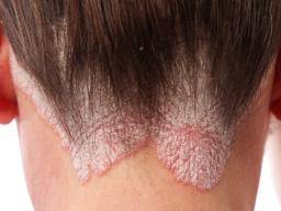 Image result for psoriasis hair