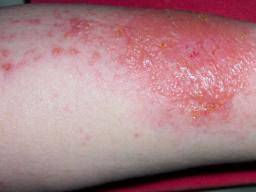 Image result for irritant contact dermatitis