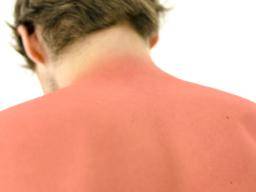 Vitamin D may help to treat sunburn, study suggests