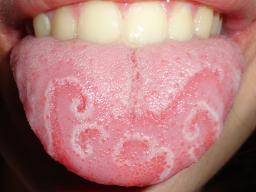 Image result for red tongue with white patterns