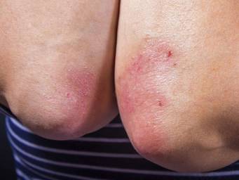How to prevent psoriasis from spreading