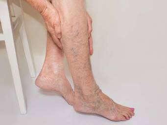 Home remedies for varicose veins