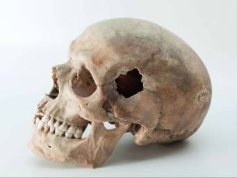 Skull-drilling: The ancient roots of modern neurosurgery