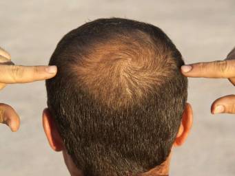 Hair loss: Scientists test wearable regrowth device