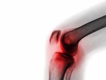 Osteoarthritis: New compound may stop the disease